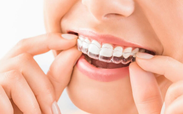 Your Clear Aligners